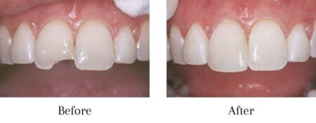 Side-by-side photos of a person's smile before and after receiving front tooth dental bonding restoration.