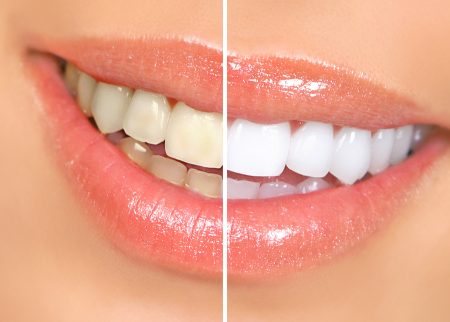Side-by-side photos show the difference in brightness in a woman's smile before and after teeth whitening.